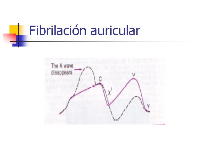 Fibrilación auricular 