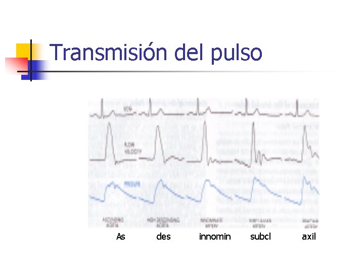 Transmisión del pulso As des innomin subcl axil 