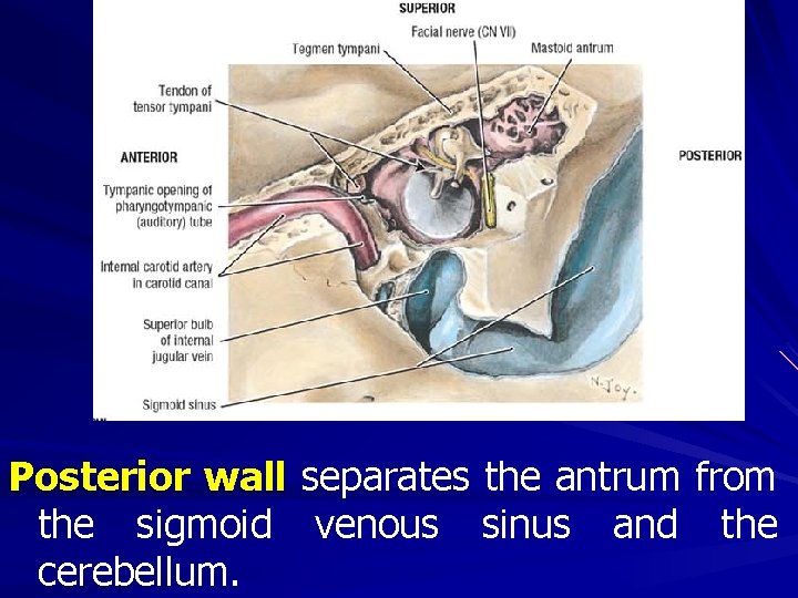 Posterior wall separates the antrum from the sigmoid venous sinus and the cerebellum. 