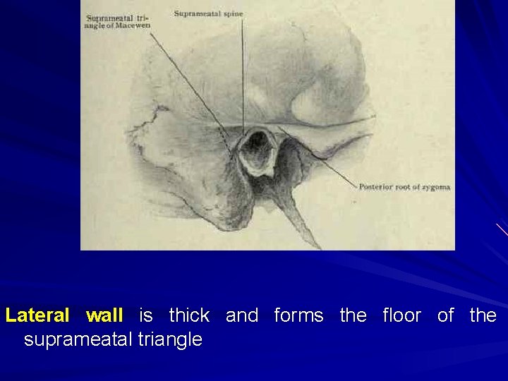 Lateral wall is thick and forms the floor of the suprameatal triangle 
