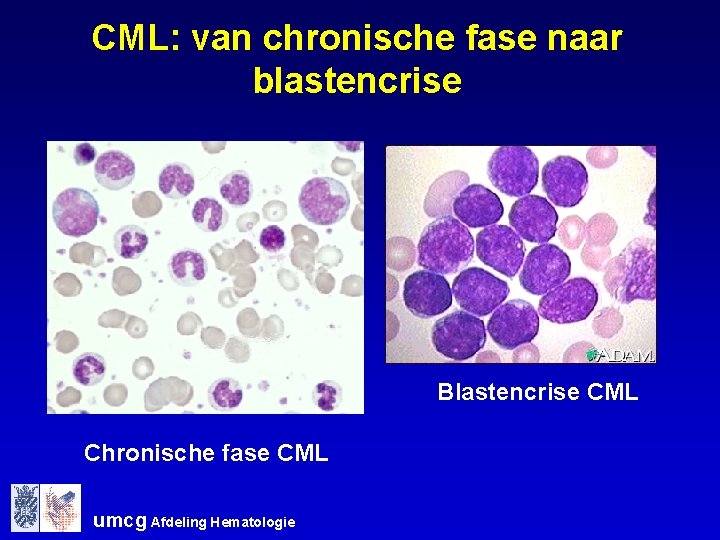 CML: van chronische fase naar blastencrise Blastencrise CML Chronische fase CML umcg Afdeling Hematologie