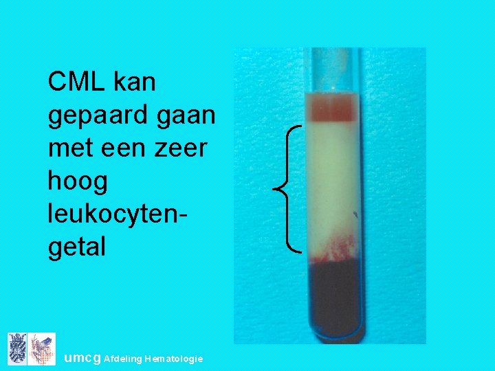 CML kan gepaard gaan met een zeer hoog leukocytengetal umcg Afdeling Hematologie 