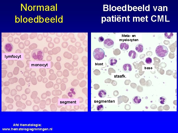 Normaal bloedbeeld Bloedbeeld van patiënt met CML Meta- en myelocyten lymfocyt blast monocyt baso
