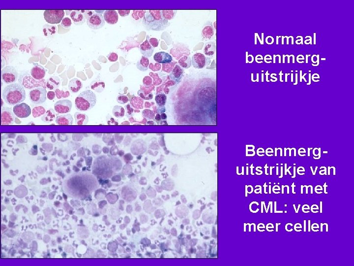 Normaal beenmerguitstrijkje Beenmerguitstrijkje van patiënt met CML: veel meer cellen 