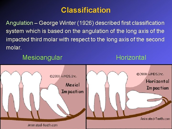 Classification Angulation – George Winter (1926) described first classification system which is based on