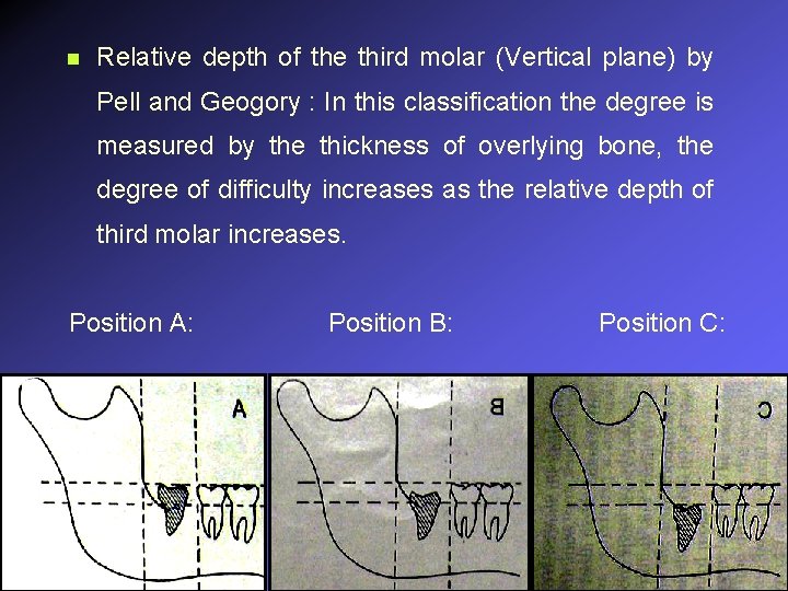 n Relative depth of the third molar (Vertical plane) by Pell and Geogory :