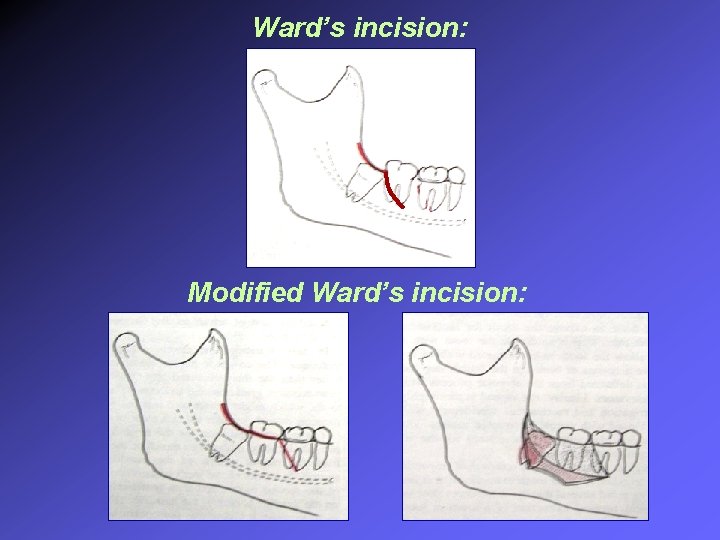Ward’s incision: Modified Ward’s incision: 