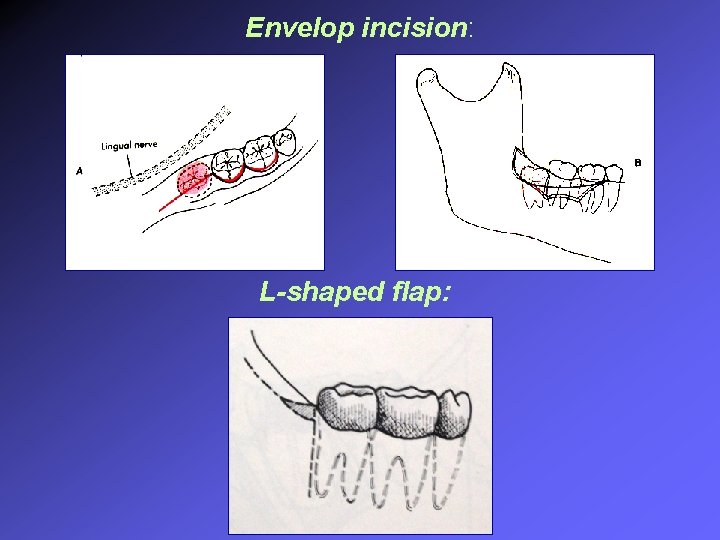 Envelop incision: L-shaped flap: 