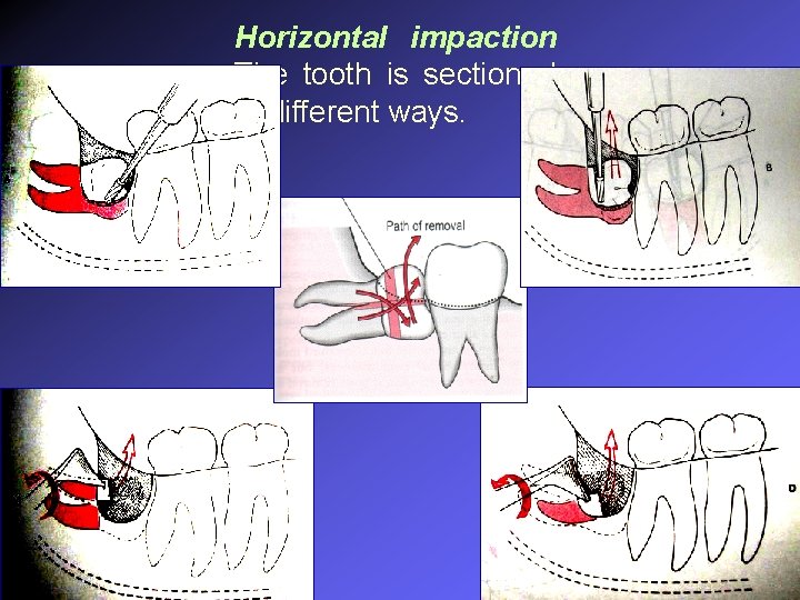 Horizontal impaction The tooth is sectioned in different ways. 