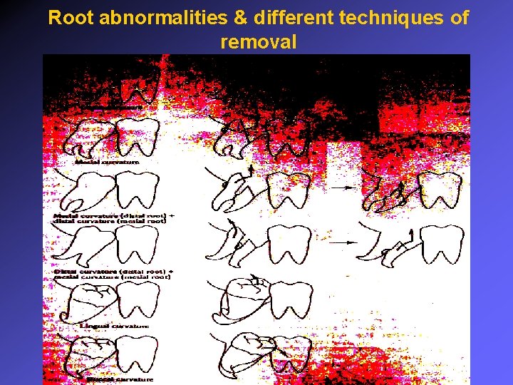 Root abnormalities & different techniques of removal 