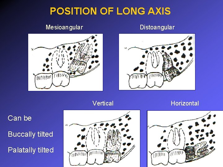 POSITION OF LONG AXIS Mesioangular Distoangular Vertical Can be Buccally tilted Palatally tilted Horizontal