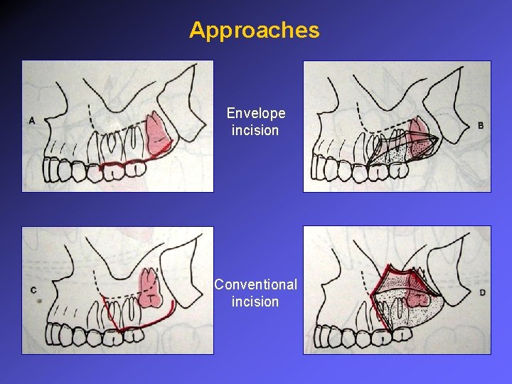 Approaches Envelope incision Conventional incision 