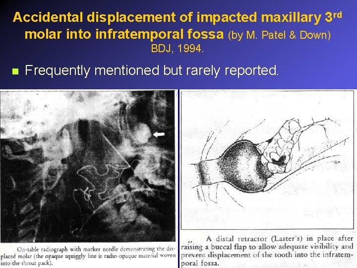 Accidental displacement of impacted maxillary 3 rd molar into infratemporal fossa (by M. Patel