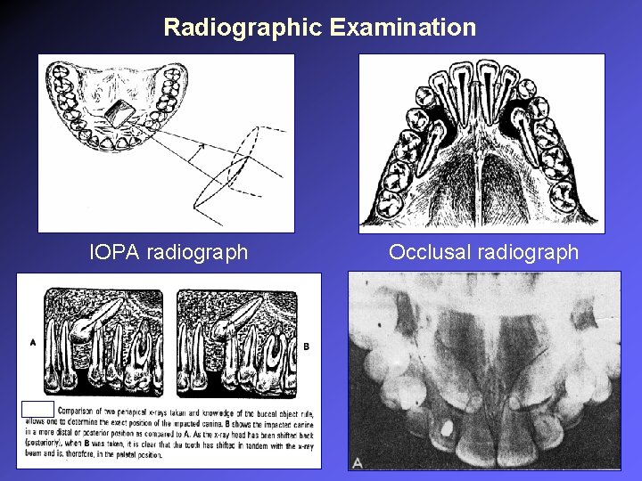 Radiographic Examination IOPA radiograph Occlusal radiograph 