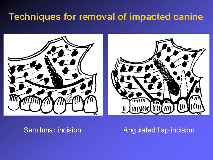 Techniques for removal of impacted canine Semilunar incision Angulated flap incision 