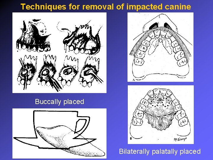 Techniques for removal of impacted canine Buccally placed Bilaterally palatally placed 