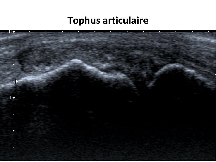 Tophus articulaire 