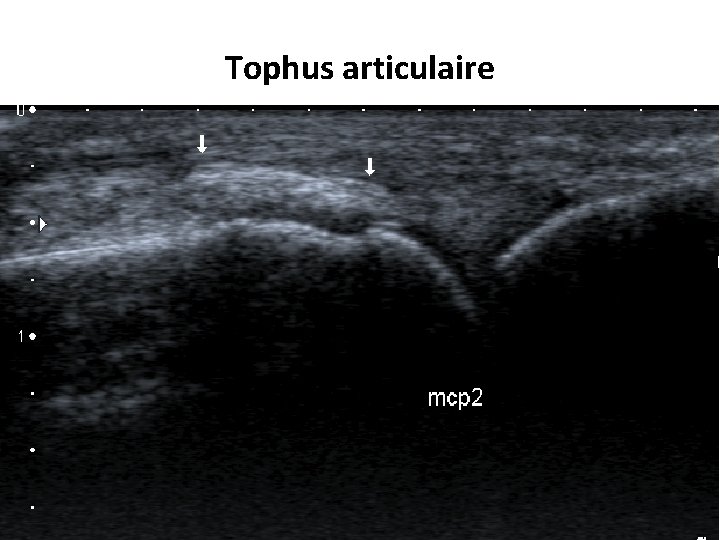 Tophus articulaire 