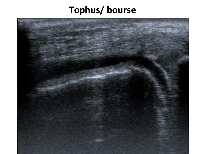 Tophus/ bourse 