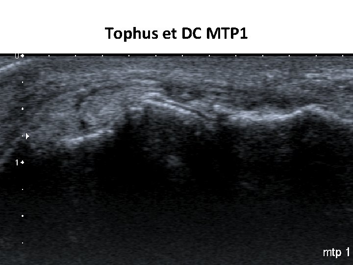 Tophus et DC MTP 1 