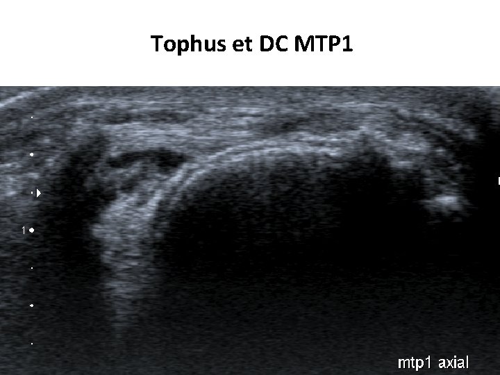 Tophus et DC MTP 1 