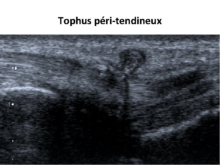 Tophus péri-tendineux 