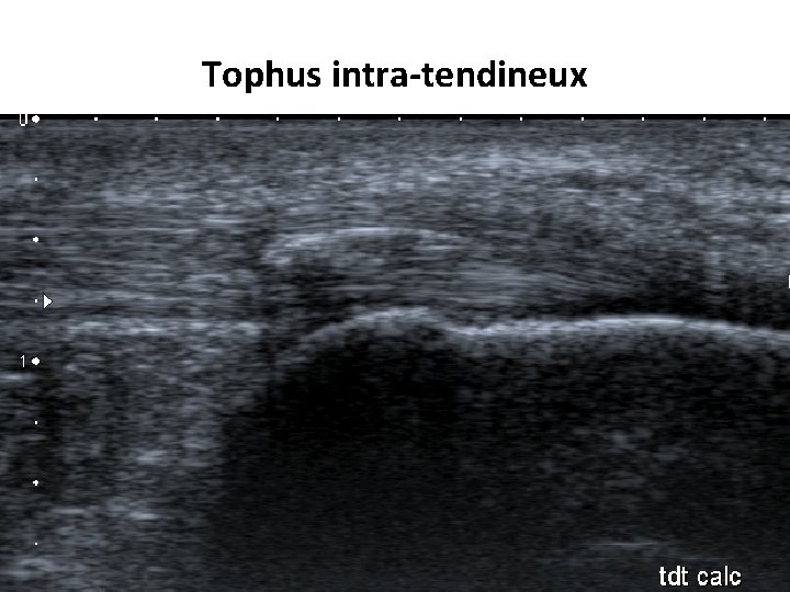 Tophus intra-tendineux 