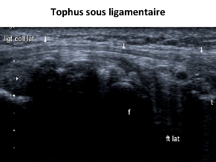 Tophus sous ligamentaire 