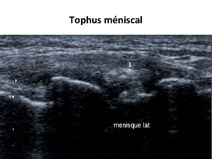 Tophus méniscal 