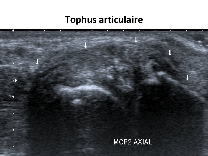 Tophus articulaire 