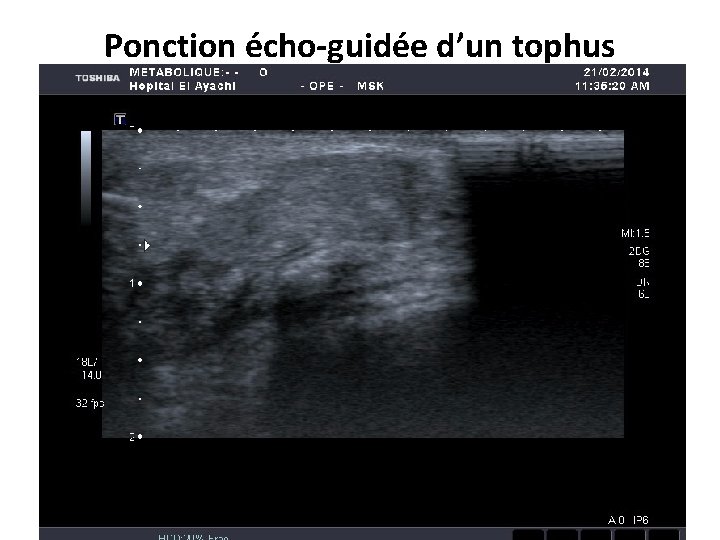 Ponction écho-guidée d’un tophus 