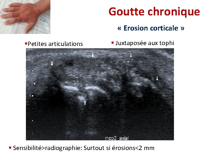 Goutte chronique « Erosion corticale » §Petites articulations § Juxtaposée aux tophi § Sensibilité>radiographie: