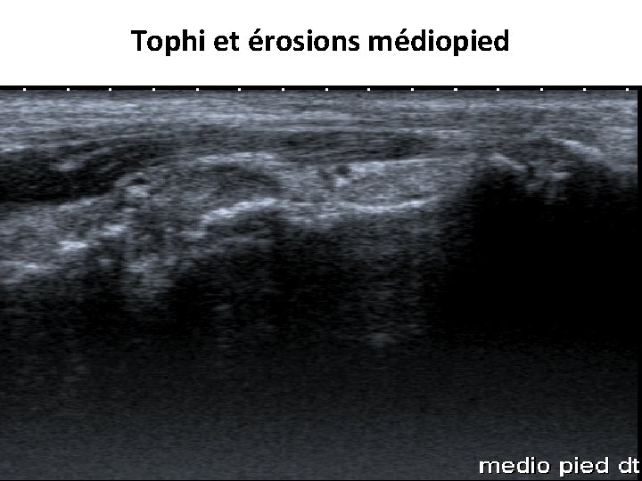 Tophi et érosions médiopied 