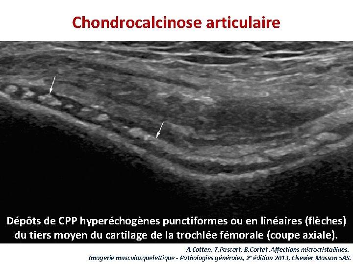 Chondrocalcinose articulaire Dépôts de CPP hyperéchogènes punctiformes ou en linéaires (flèches) du tiers moyen