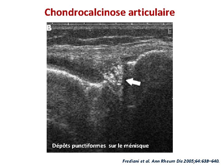 Chondrocalcinose articulaire Dépôts punctiformes sur le ménisque Frediani et al. Ann Rheum Dis 2005;