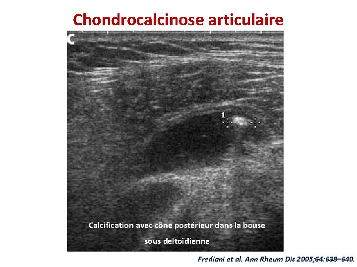 Chondrocalcinose articulaire Calcification avec cône postérieur dans la bouse sous deltoïdienne Frediani et al.