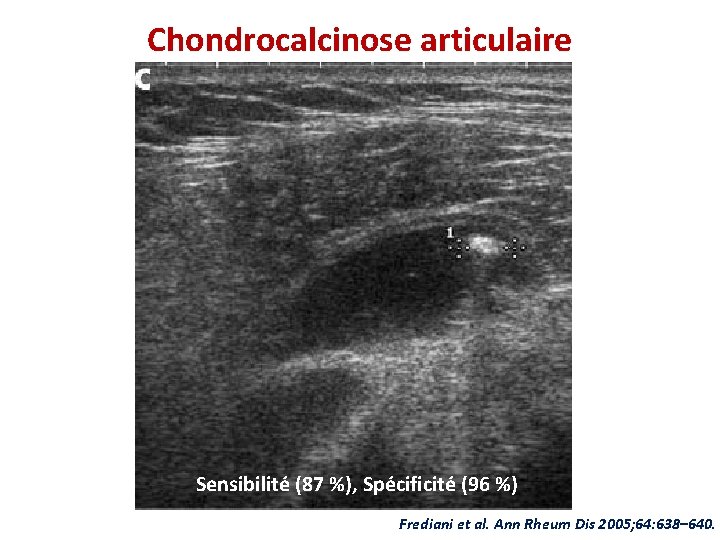 Chondrocalcinose articulaire Sensibilité (87 %), Spécificité (96 %) Frediani et al. Ann Rheum Dis