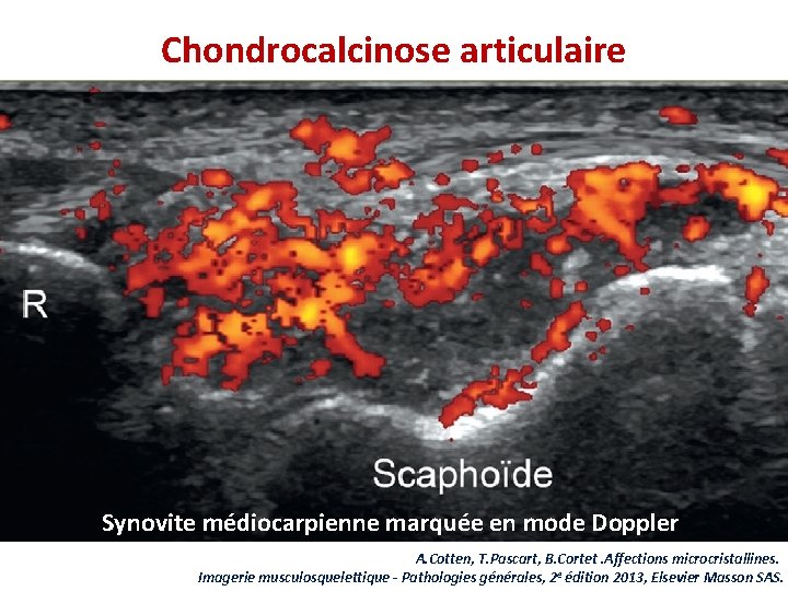 Chondrocalcinose articulaire Synovite médiocarpienne marquée en mode Doppler A. Cotten, T. Pascart, B. Cortet.