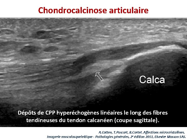 Chondrocalcinose articulaire Dépôts de CPP hyperéchogènes linéaires le long des fibres tendineuses du tendon