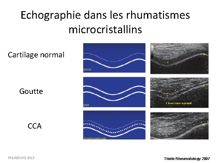 Echographie dans les rhumatismes microcristallins Cartilage normal Goutte CCA RHUMECHO 2013 Thiele Rheumatology 2007