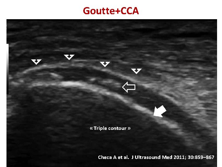 Goutte+CCA « Triple contour » Checa A et al. J Ultrasound Med 2011; 30: