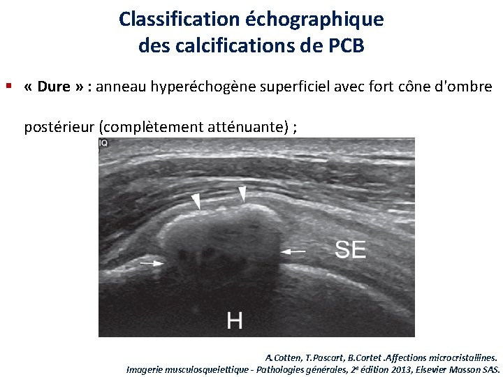 Classification échographique des calcifications de PCB § « Dure » : anneau hyperéchogène superficiel