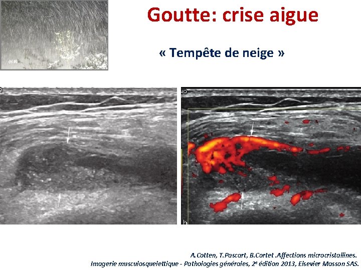 Goutte: crise aigue « Tempête de neige » A. Cotten, T. Pascart, B. Cortet.