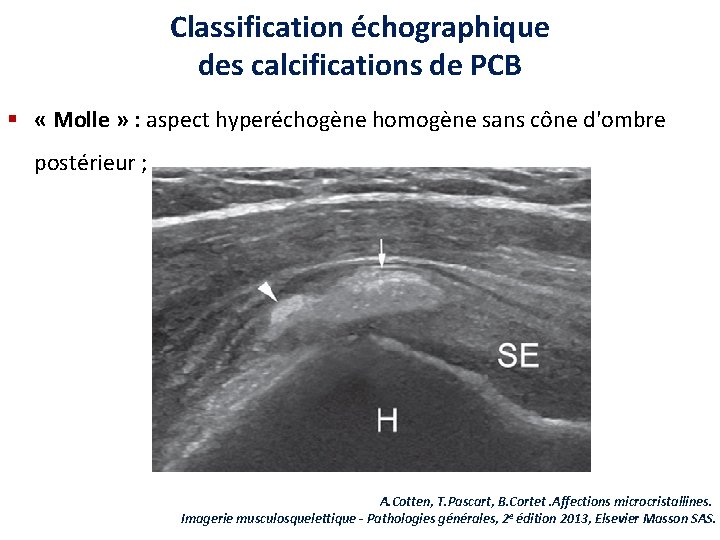 Classification échographique des calcifications de PCB § « Molle » : aspect hyperéchogène homogène