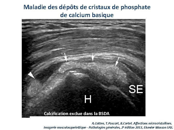 Maladie des dépôts de cristaux de phosphate de calcium basique Calcification exclue dans la