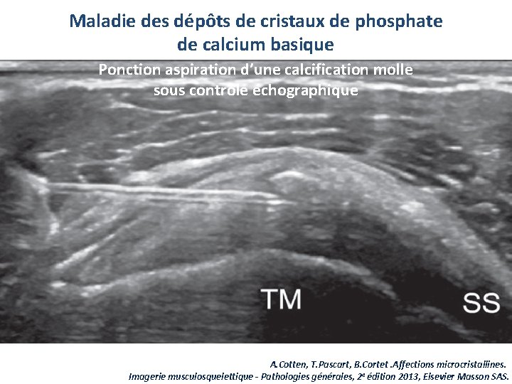 Maladie des dépôts de cristaux de phosphate de calcium basique Ponction aspiration d’une calcification