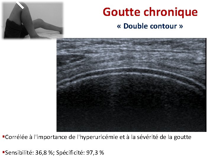 Goutte chronique « Double contour » §Corrélée à l'importance de l'hyperuricémie et à la