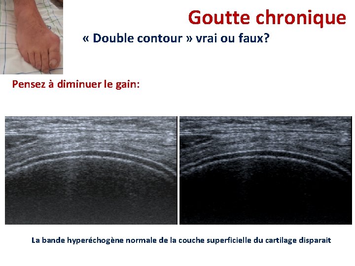 Goutte chronique « Double contour » vrai ou faux? Pensez à diminuer le gain: