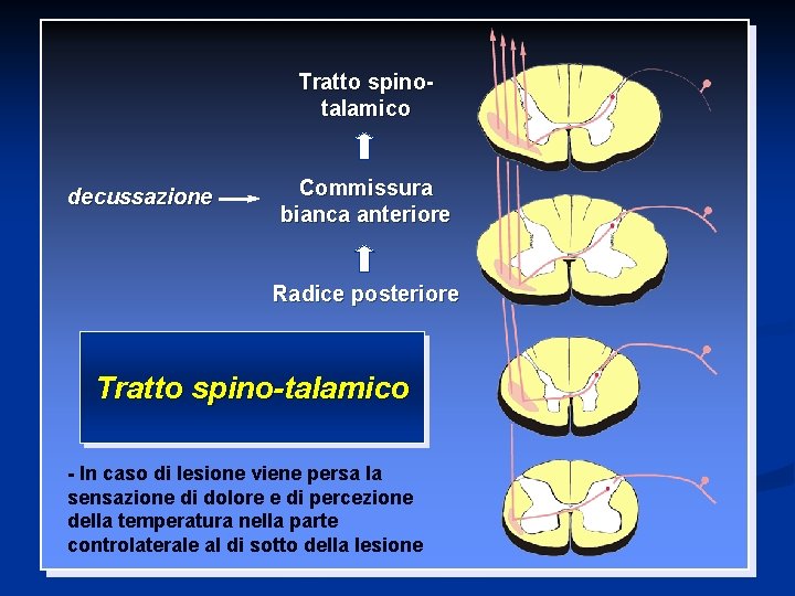 Tratto spinotalamico decussazione Commissura bianca anteriore Radice posteriore Tratto spino-talamico - In caso di