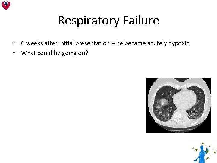 Respiratory Failure • 6 weeks after initial presentation – he became acutely hypoxic • Respiratory Failure • 6 weeks after initial presentation – he became acutely hypoxic •